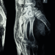 Personal Injury Claims in WV