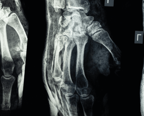 Personal Injury Claims in WV