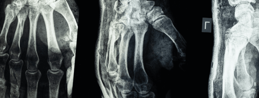 Personal Injury Claims in WV