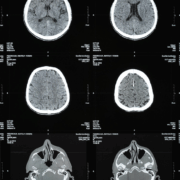 Traumatic Brain Injuries in West Virginia Car Crashes