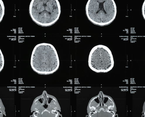Traumatic Brain Injuries in West Virginia Car Crashes