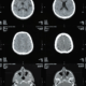 Traumatic Brain Injuries in West Virginia Car Crashes