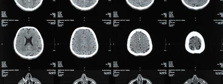 Traumatic Brain Injuries in West Virginia Car Crashes