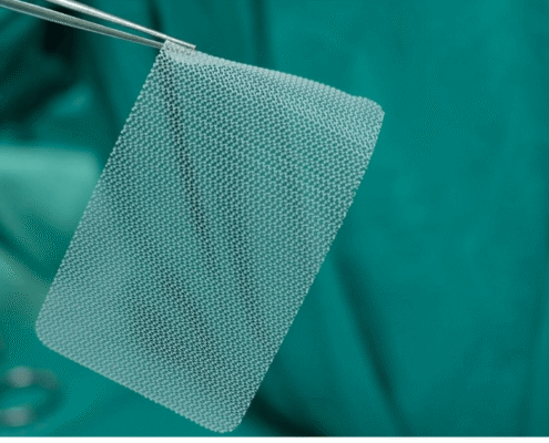 C.R. Bard Hernia Mesh Litigation_ What Victims Should Know About the Latest Verdicts and Settlements